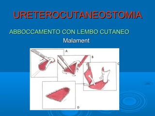 URETEROCUTANEOSTOMIA
ABBOCCAMENTO CON LEMBO CUTANEO
             Malament
 