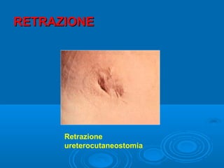 RETRAZIONE




      Retrazione
      ureterocutaneostomia
 