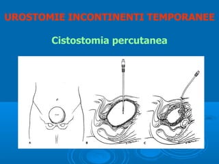 UROSTOMIE INCONTINENTI TEMPORANEE

       Cistostomia percutanea
 
