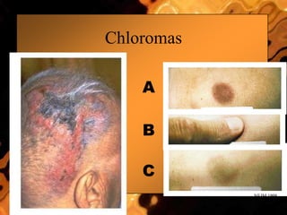 A
B
C
Chloromas
NEJM 1998
 