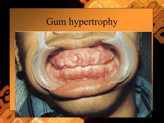Gum hypertrophy
 