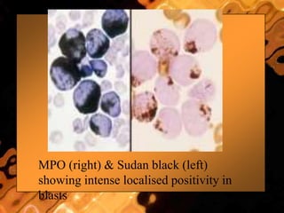 MPO (right) & Sudan black (left)
showing intense localised positivity in
blasts
 