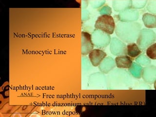 Non-Specific Esterase
Monocytic Line
Naphthyl acetate
ANAE > Free naphthyl compounds
+Stable diazonium salt (eg, Fast blue RR)
> Brown deposits
 