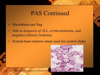 PAS Continued
• Myeloblasts are Neg
• Aids in diagnosis of ALL, erythroleukemia, and
megakaryoblastic leukemia
• Normal bone marrow smear used for control slides
http://www.pathologyoutlines.com/leukemia.html
 