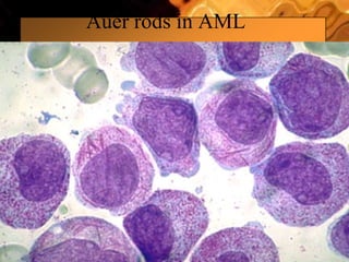 Auer rods in AML
 