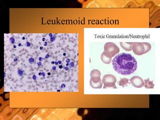 Leukemoid reaction
 