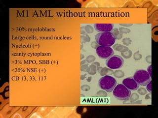 M1 AML without maturation
 > 30% myeloblasts
 Large cells, round nucleus
 Nucleoli (+)
 scanty cytoplasm
 >3% MPO, SBB (+)
 <20% NSE (+)
 CD 13, 33, 117
 