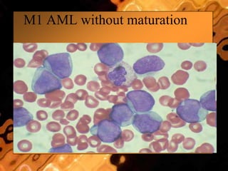 M1 AML without maturation
 