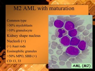 M2 AML with maturation
• Common type
• >30% myeloblasts
• >10% granulocyte
• Kidney shape nucleus
• Nucleoli (+)
• (+) Auer rods
• Eosinophilic granules
• >50% MPO, SBB (+)
• CD 13, 33
 