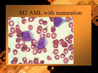 M2 AML with maturation
 