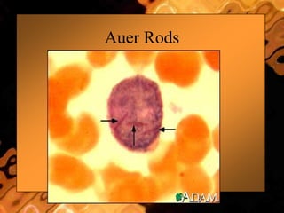Auer Rods
 
