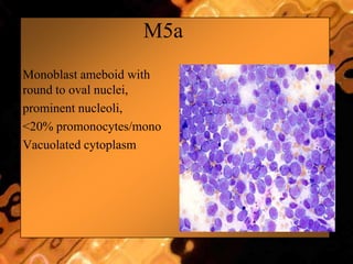 M5a
• Monoblast ameboid with
round to oval nuclei,
• prominent nucleoli,
• <20% promonocytes/mono
• Vacuolated cytoplasm
 