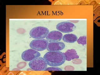 AML M5b
 