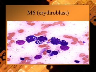M6 (erythroblast)
 