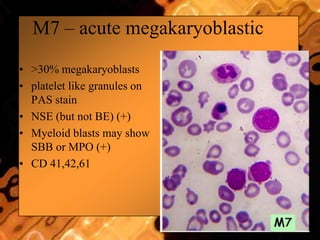 M7 – acute megakaryoblastic
• >30% megakaryoblasts
• platelet like granules on
PAS stain
• NSE (but not BE) (+)
• Myeloid blasts may show
SBB or MPO (+)
• CD 41,42,61
 