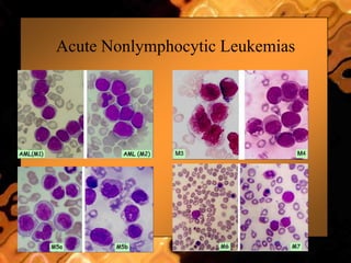 Acute Nonlymphocytic Leukemias
 