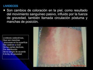 LIVIDECES Son cambios de coloración en la piel, como resultado del movimiento sanguíneo pasivo, influido por la fuerza de gravedad, también llamada circulación póstuma y manchas de posición. Livideces cadavéricas, Que son manchas procureas en la superficie  Del cadáver a nivel  De las partes declives,  Por distribución De la sangre de acuerdo A la ley de gravedad 