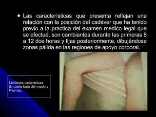 Las características que presenta reflejan una relación con la posición del cadáver que ha tenido previo a la practica del examen medico legal que se efectué, son cambiantes durante las primeras 8 a 12 doe horas y fijas posteriormente, dibujándose zonas pálida en las regiones de apoyo corporal. Livideces cadavéricas En parte baja del muslo y  Piernas. 
