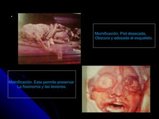 . Momificación. Piel desecada,  Obscura y adosada al esqueleto. Momificación. Esta permite preservar  La fisionomia y las lesiones. 