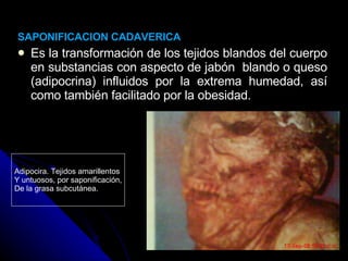 SAPONIFICACION CADAVERICA Es la transformación de los tejidos blandos del cuerpo en substancias con aspecto de jabón  blando o queso (adipocrina) influidos por la extrema humedad, así como también facilitado por la obesidad. Adipocira. Tejidos amarillentos Y untuosos, por saponificación, De la grasa subcutánea. 
