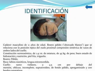 IDENTIFICACIÓN



Cadáver masculino de 11 años de edad. Rostro pálido ("ahorcado blanco") que se
relaciona con la posición típica del nudo proximal compresión simétrica de vasos de
ambos lados del cuello.
Constitución normosómica, de 1.41 m. de estatura, de 45 kg. de peso, buen estado de
hidratación y nutrición, piel fría, trigueña.
Rostro: Pálido.
Boca: labios cianóticos, lengua entremordida.
Cuello:      surco       violáceo,       a    4.5   cm      por      debajo     del
mentón, oblicuo, incompleto, supratiroideo, de fondo pálido, apergaminado y con
 