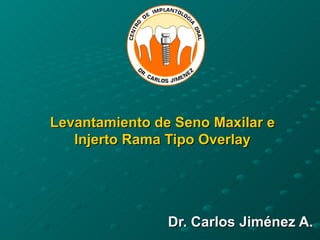 Levantamiento de Seno Maxilar e Injerto Rama Tipo Overlay Dr. Carlos Jiménez A. 