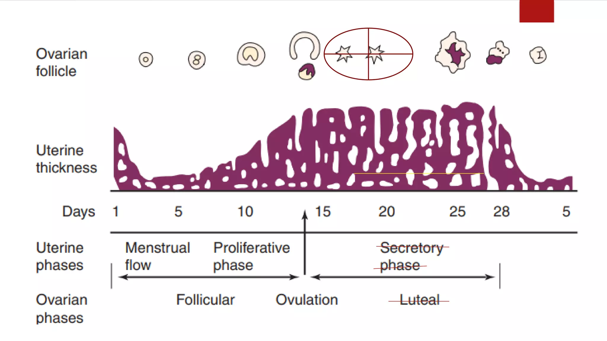 4. Luteal Phase Defect (LPD)
 Problem exists with the luteal phase that results in an incompetent uterine
lining that is essential for implantation for an embryo.
 The luteal phase is one stage of menstrual cycle. It occurs after ovulation
(when your ovaries release an egg) and before your period starts. During this
time, the lining of your uterus normally gets thicker to prepare for a possible
pregnancy.
 If you have a luteal phase defect, that lining doesn't grow properly each
month. This can make it difficult to become or remain pregnant.
 Luteal Phase Defect Results in absent or inadequate progesterone levels that
leads to incompetency of endometrial lining to support implantation or remain
pregnant. This may result to miscarriage and infertility.
 