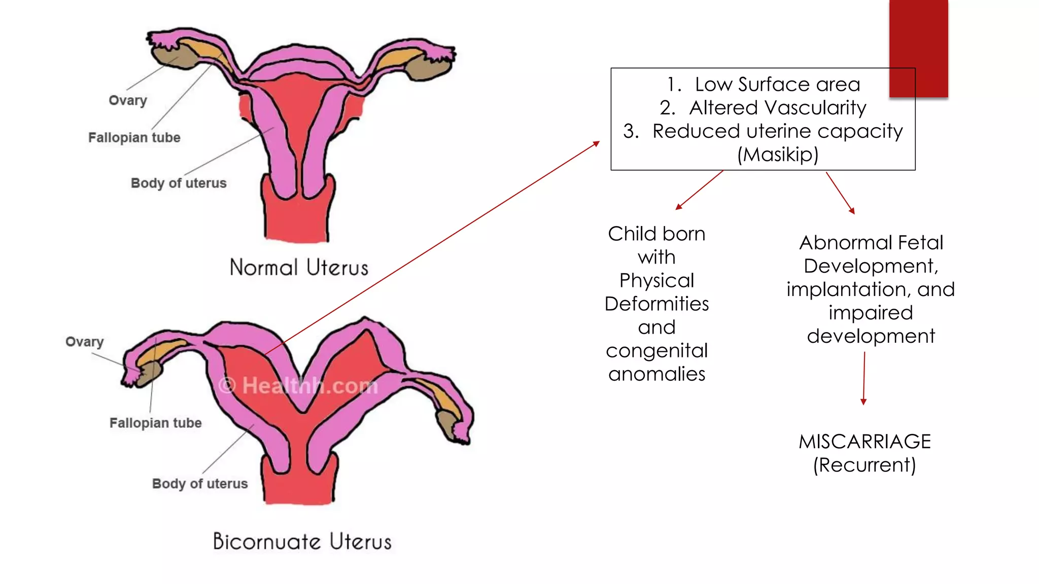 1. Low Surface area
2. Altered Vascularity
3. Reduced uterine capacity
(Masikip)
Child born
with
Physical
Deformities
and
congenital
anomalies
Abnormal Fetal
Development,
implantation, and
impaired
development
MISCARRIAGE
(Recurrent)
 