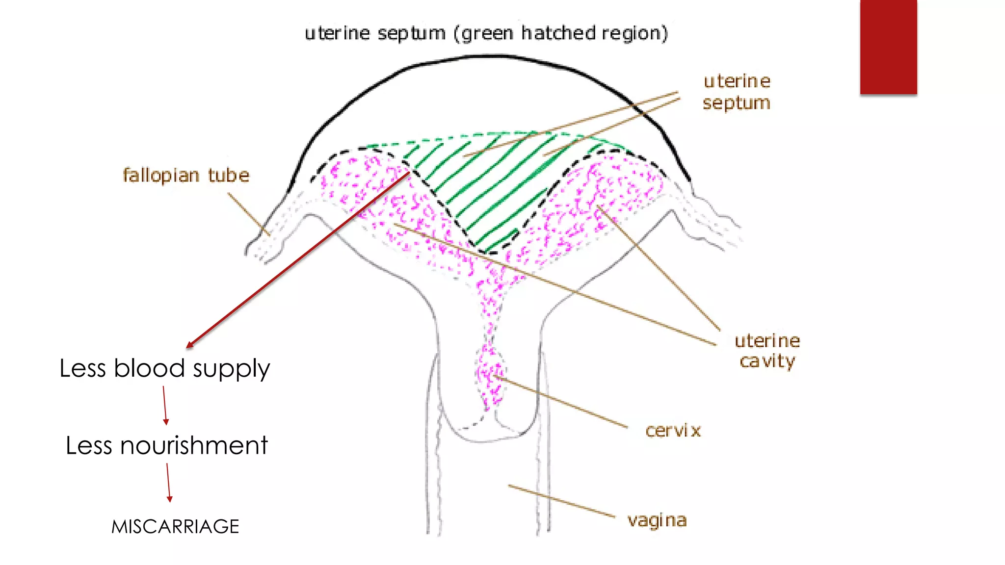 Less blood supply
Less nourishment
MISCARRIAGE
 