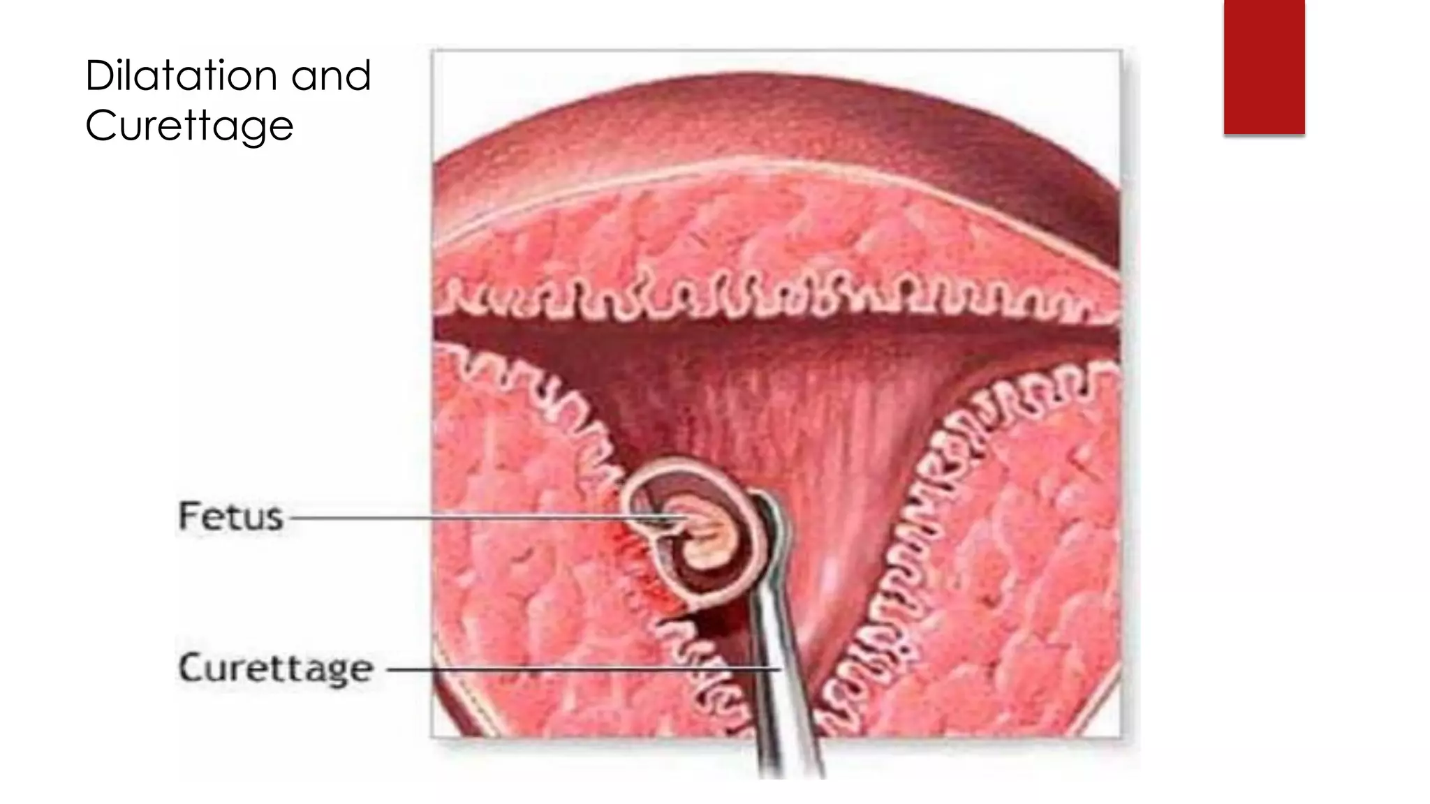 Dilatation and
Curettage
 