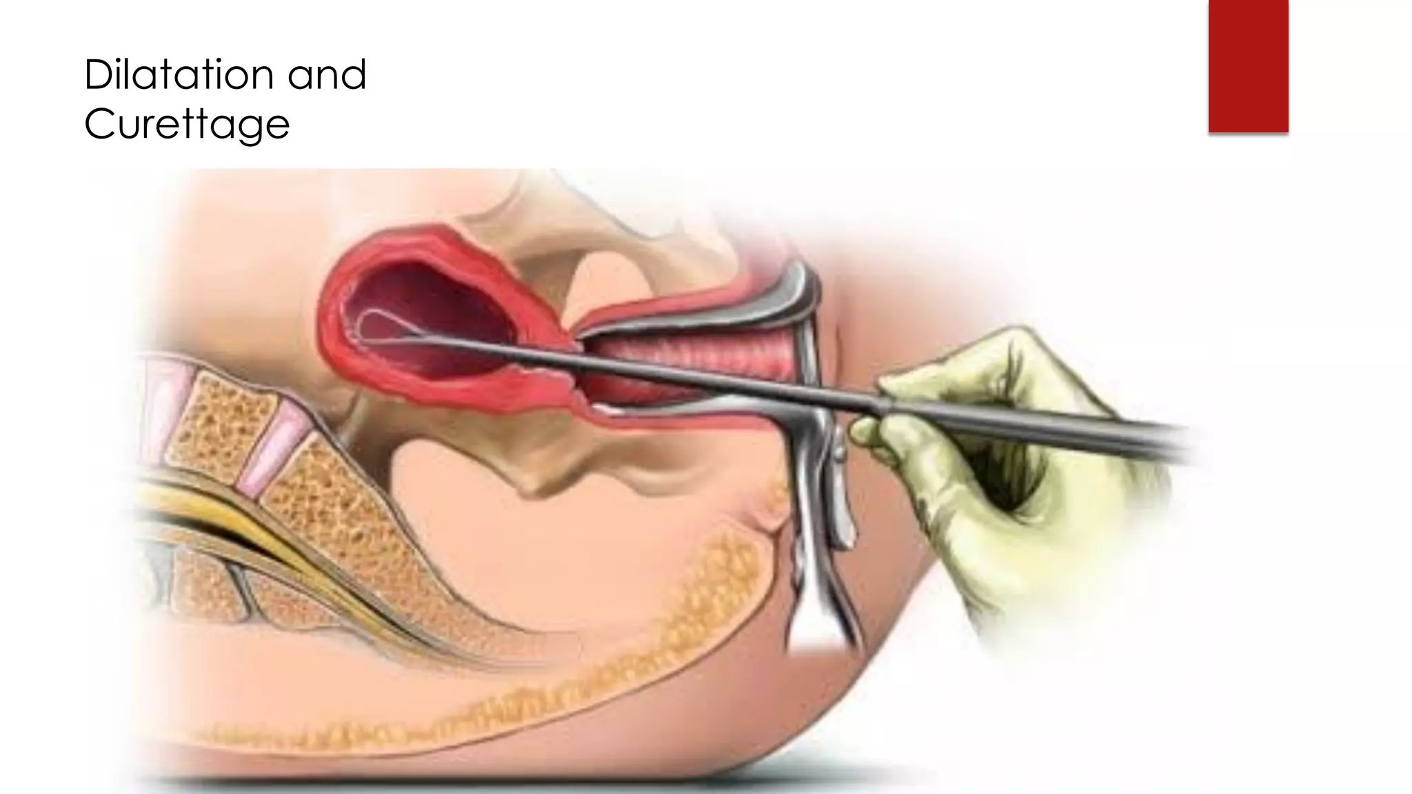 Dilatation and
Curettage
 