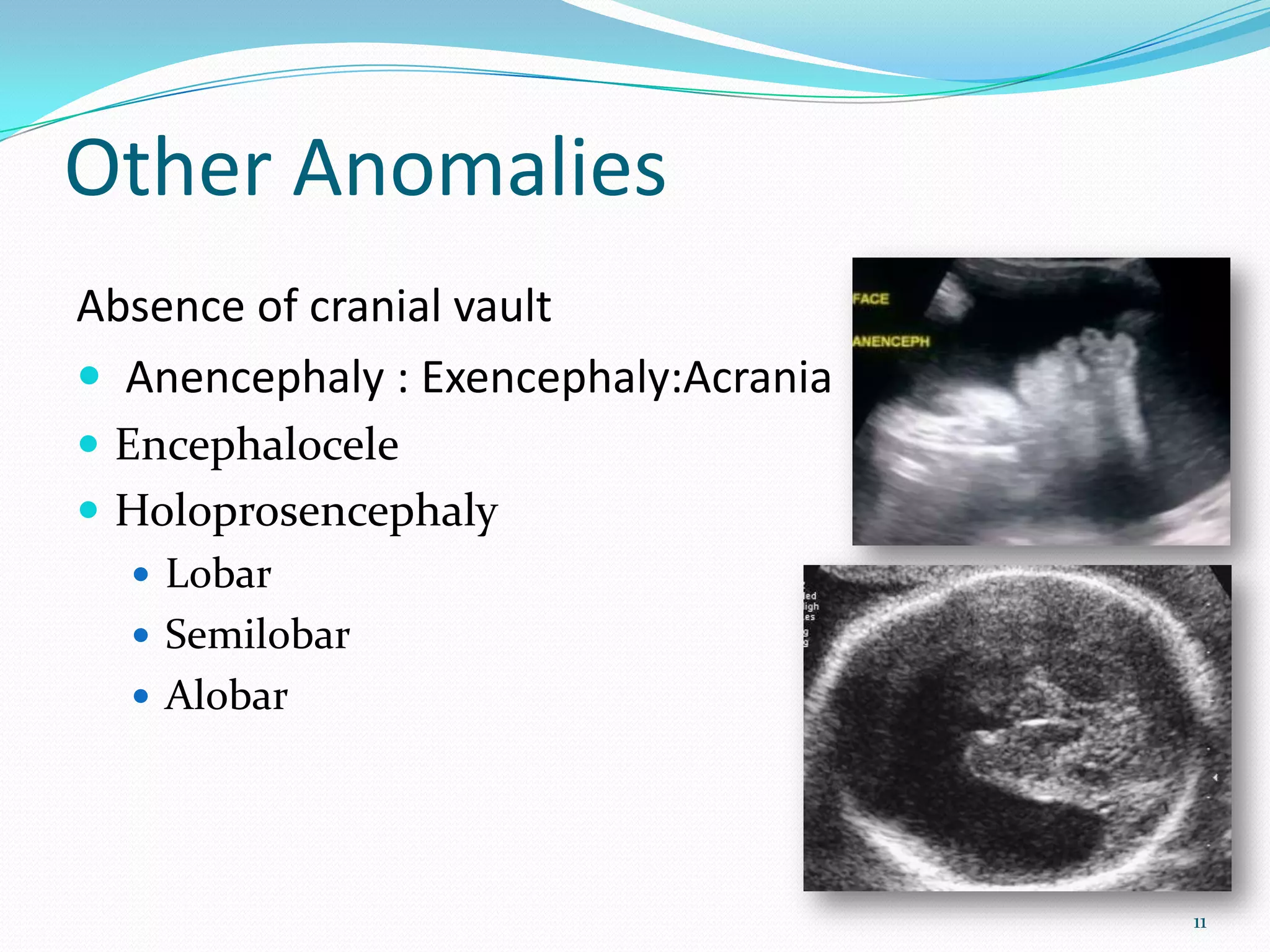 Other Anomalies
Absence of cranial vault
 Anencephaly : Exencephaly:Acrania
 Encephalocele
 Holoprosencephaly
   Lobar
   Semilobar
   Alobar




                                      11
 
