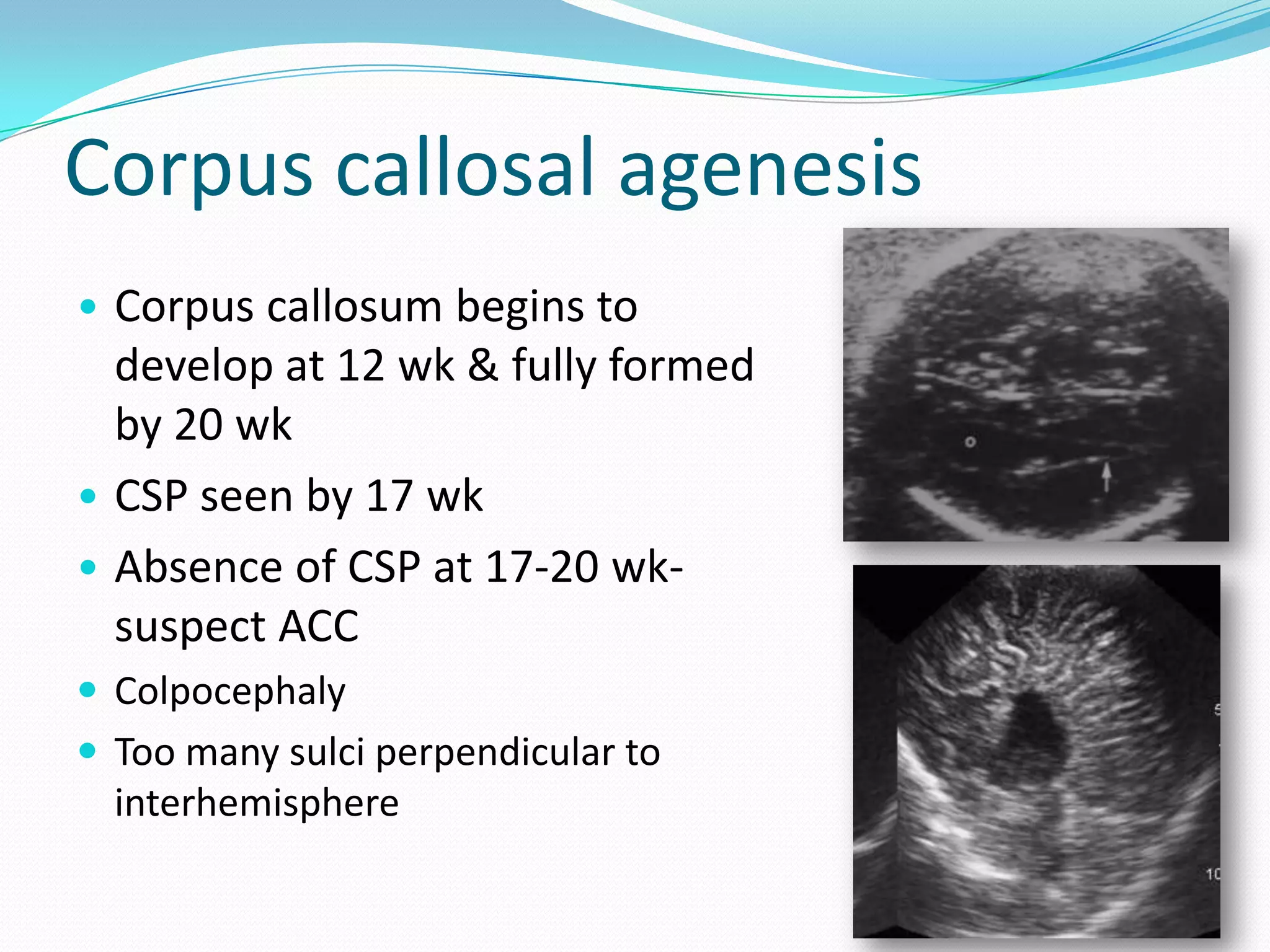 Corpus callosal agenesis
• Corpus callosum begins to
  develop at 12 wk & fully formed
  by 20 wk
• CSP seen by 17 wk
• Absence of CSP at 17-20 wk-
  suspect ACC
 Colpocephaly
 Too many sulci perpendicular to
  interhemisphere

                                    12
 
