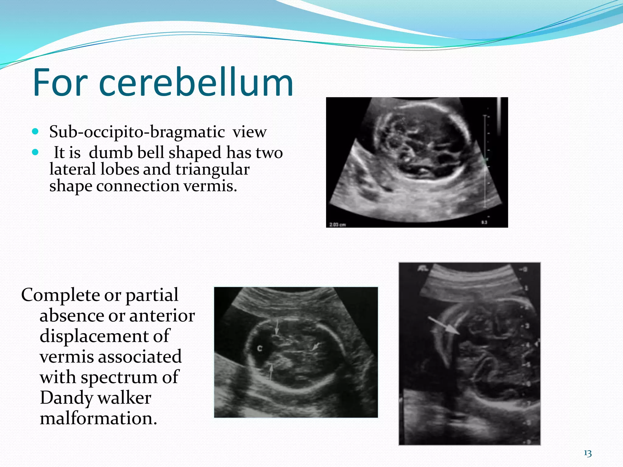 For cerebellum
  Sub-occipito-bragmatic view
  It is dumb bell shaped has two
   lateral lobes and triangular
   shape connection vermis.




Complete or partial
  absence or anterior
  displacement of
  vermis associated
  with spectrum of
  Dandy walker
  malformation.
                                    13
 