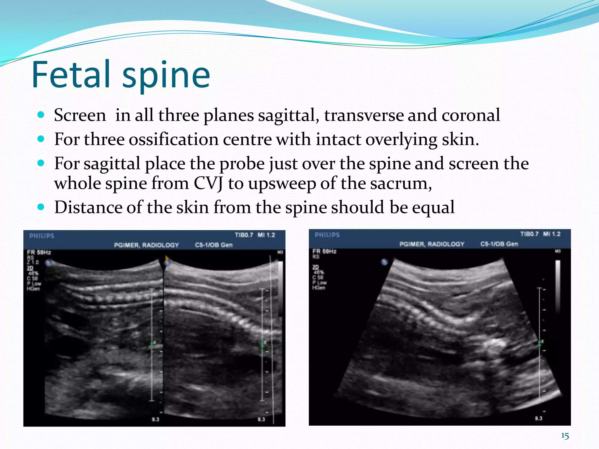 Fetal spine
 Screen in all three planes sagittal, transverse and coronal
 For three ossification centre with intact overlying skin.
 For sagittal place the probe just over the spine and screen the
  whole spine from CVJ to upsweep of the sacrum,
 Distance of the skin from the spine should be equal




       Image                        Image




                                                                    15
 