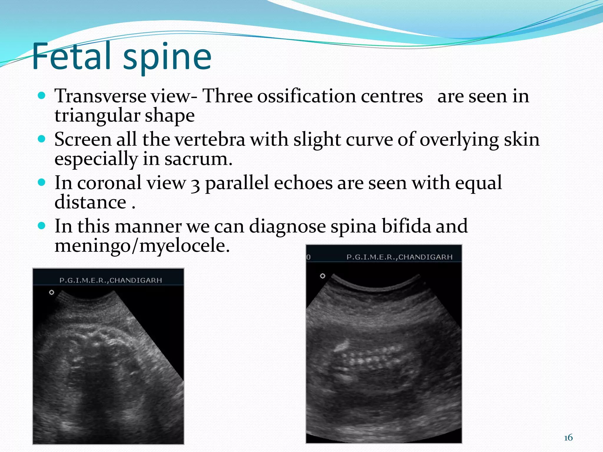 Fetal spine
 Transverse view- Three ossification centres are seen in
  triangular shape
 Screen all the vertebra with slight curve of overlying skin
  especially in sacrum.
 In coronal view 3 parallel echoes are seen with equal
  distance .
 In this manner we can diagnose spina bifida and
  meningo/myelocele.




                                                                16
 
