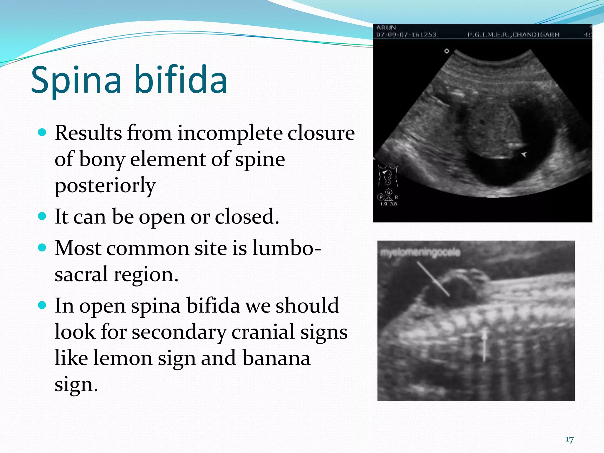 Spina bifida
 Results from incomplete closure
  of bony element of spine
  posteriorly
 It can be open or closed.
 Most common site is lumbo-
  sacral region.
 In open spina bifida we should
  look for secondary cranial signs
  like lemon sign and banana
  sign.

                                     17
 