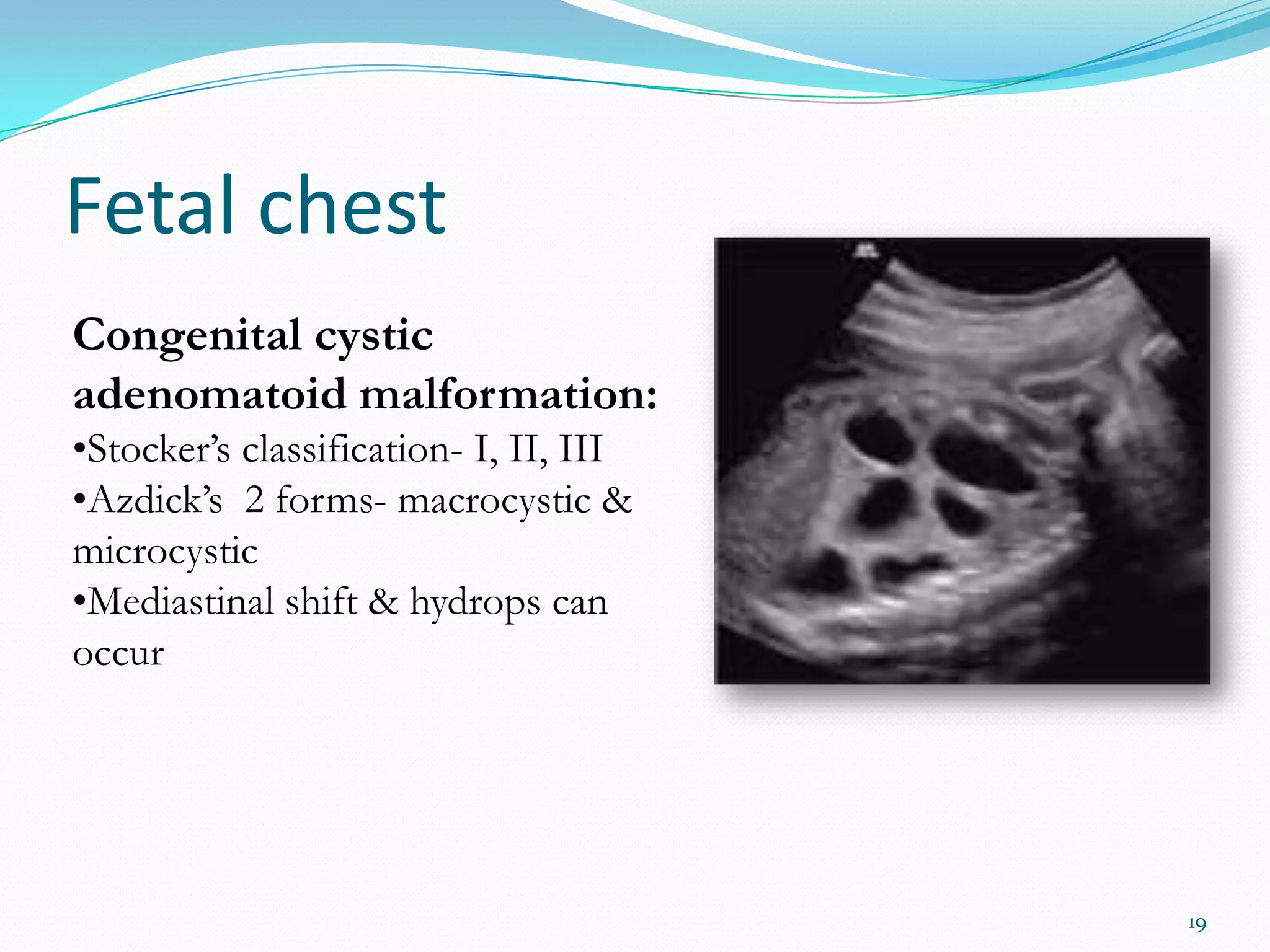 Fetal chest
Congenital cystic
adenomatoid malformation:
•Stocker’s classification- I, II, III
•Azdick’s 2 forms- macrocystic &
microcystic
•Mediastinal shift & hydrops can
occur




                                        19
 
