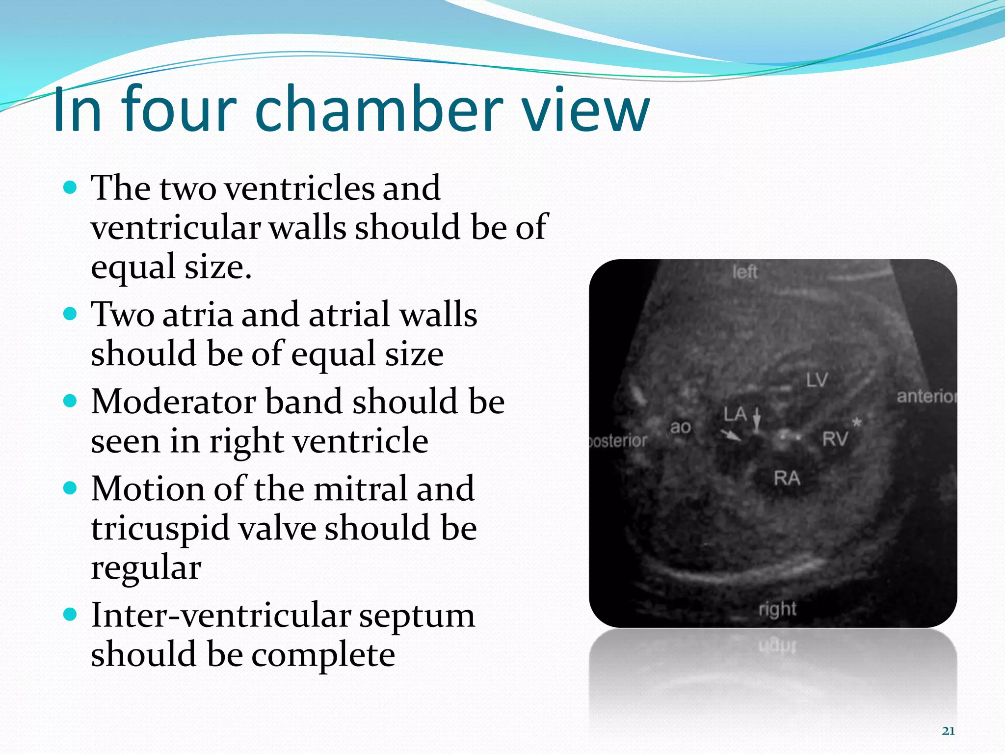 In four chamber view
 The two ventricles and
    ventricular walls should be of
    equal size.
   Two atria and atrial walls
    should be of equal size
   Moderator band should be
    seen in right ventricle
   Motion of the mitral and
    tricuspid valve should be
    regular
   Inter-ventricular septum
    should be complete
                                     21
 