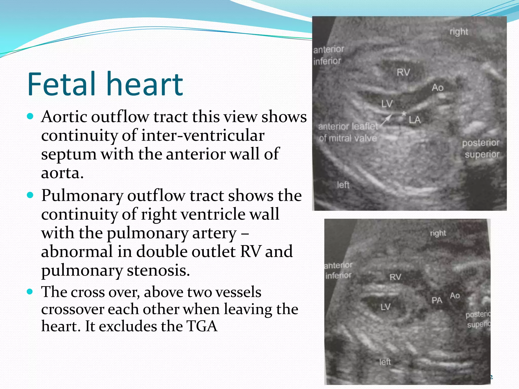 Fetal heart
 Aortic outflow tract this view shows
  continuity of inter-ventricular
  septum with the anterior wall of
  aorta.
 Pulmonary outflow tract shows the
  continuity of right ventricle wall
  with the pulmonary artery –
  abnormal in double outlet RV and
  pulmonary stenosis.
 The cross over, above two vessels
  crossover each other when leaving the
  heart. It excludes the TGA


                                          22
 