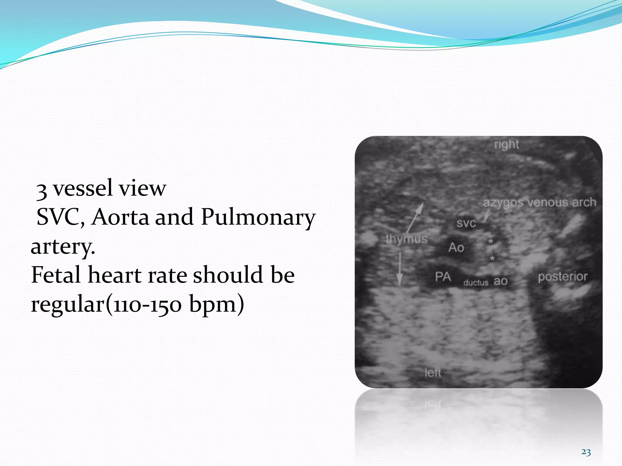 3 vessel view
 SVC, Aorta and Pulmonary
artery.
Fetal heart rate should be
regular(110-150 bpm)




                             23
 