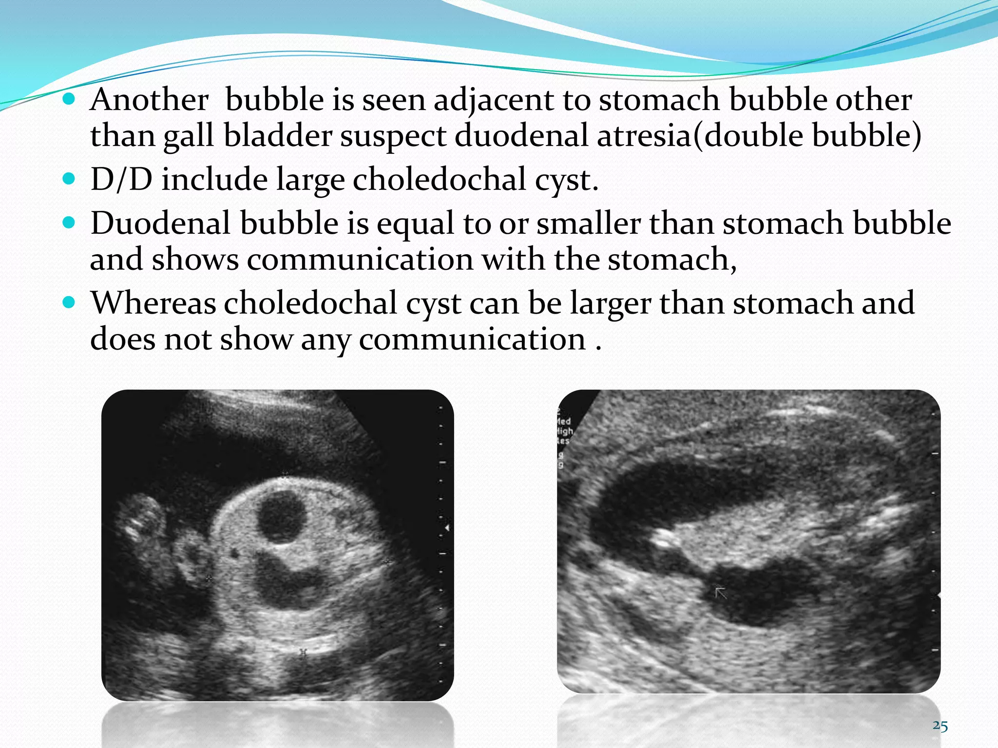  Another bubble is seen adjacent to stomach bubble other
  than gall bladder suspect duodenal atresia(double bubble)
 D/D include large choledochal cyst.
 Duodenal bubble is equal to or smaller than stomach bubble
  and shows communication with the stomach,
 Whereas choledochal cyst can be larger than stomach and
  does not show any communication .




                                                            25
 