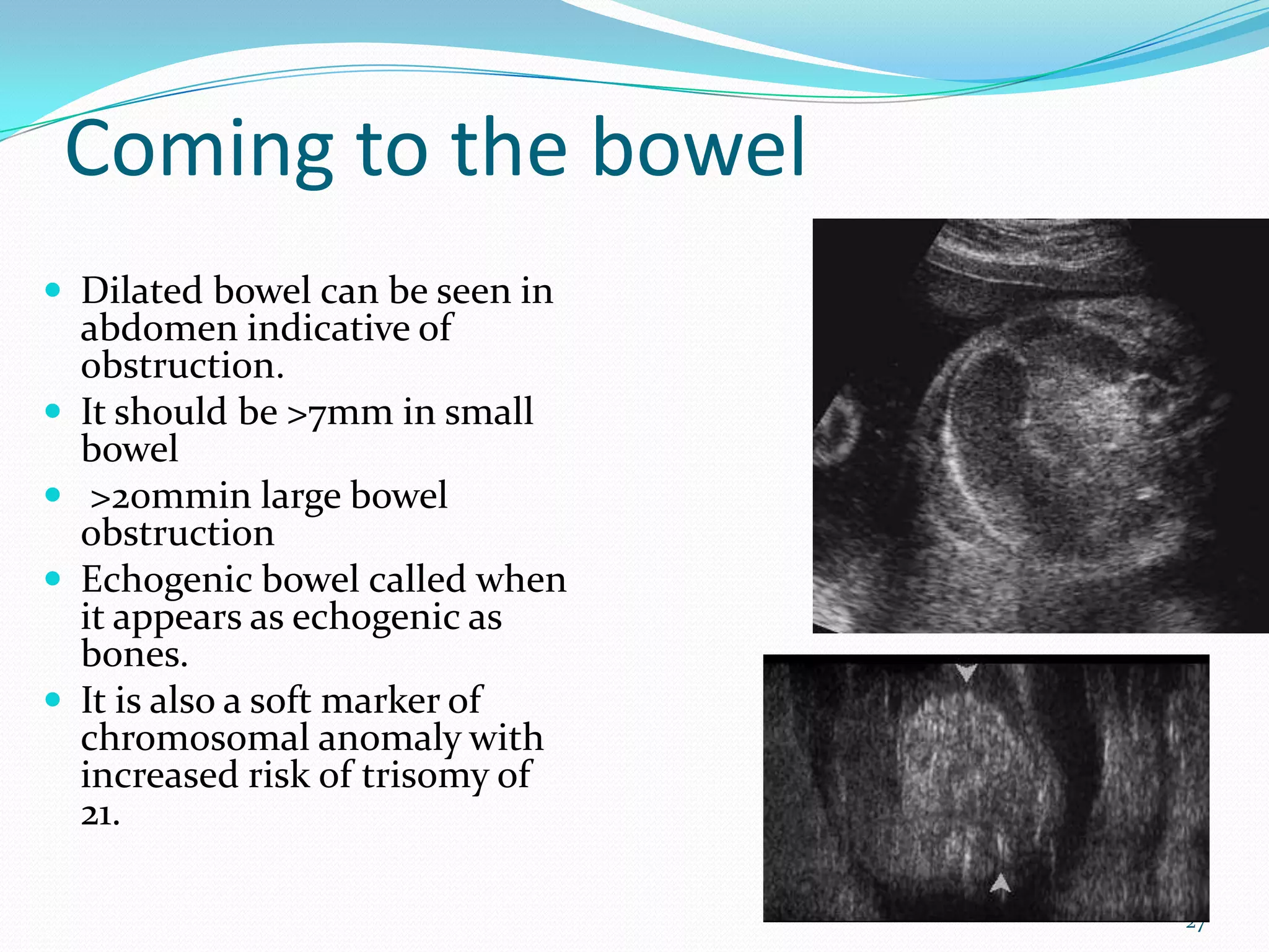Coming to the bowel
 Dilated bowel can be seen in
    abdomen indicative of
    obstruction.
   It should be >7mm in small
    bowel
    >20mmin large bowel
    obstruction
   Echogenic bowel called when
    it appears as echogenic as
    bones.
   It is also a soft marker of
    chromosomal anomaly with
    increased risk of trisomy of
    21.

                                   27
 