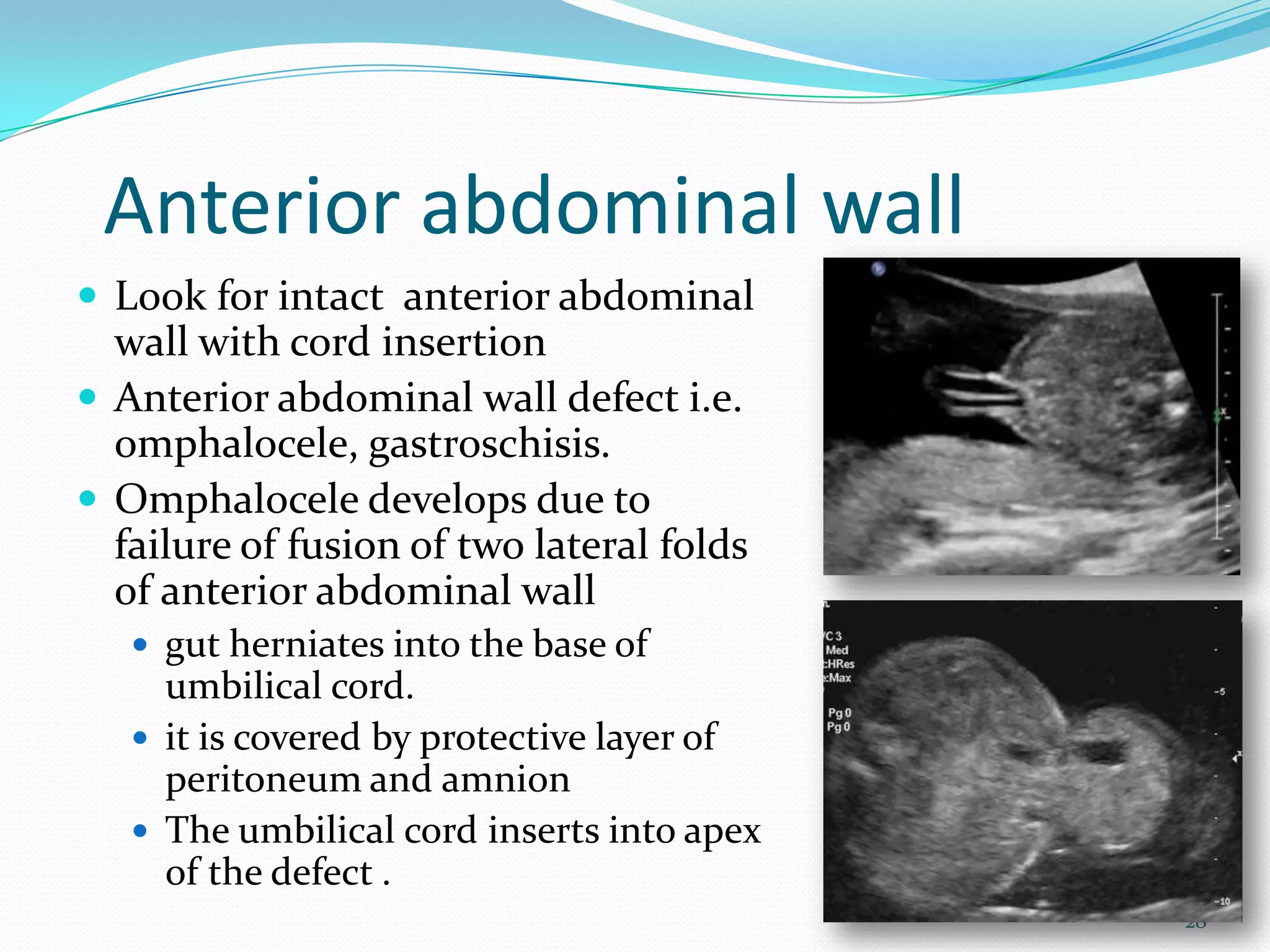 Anterior abdominal wall
 Look for intact anterior abdominal
  wall with cord insertion
 Anterior abdominal wall defect i.e.
  omphalocele, gastroschisis.
 Omphalocele develops due to
  failure of fusion of two lateral folds
  of anterior abdominal wall
    gut herniates into the base of
     umbilical cord.
    it is covered by protective layer of
     peritoneum and amnion
    The umbilical cord inserts into apex
     of the defect .
                                            28
 