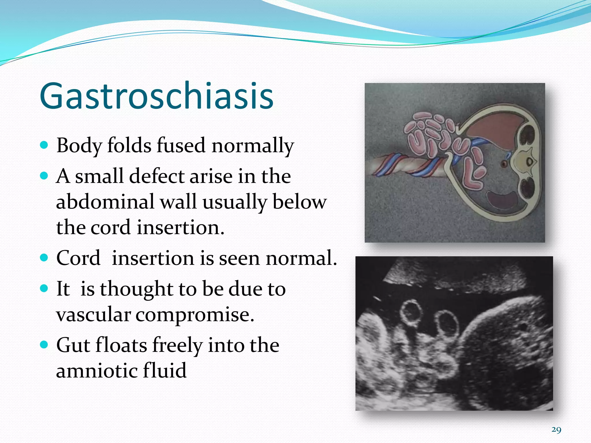 Gastroschiasis
 Body folds fused normally
 A small defect arise in the
  abdominal wall usually below
  the cord insertion.
 Cord insertion is seen normal.
 It is thought to be due to
  vascular compromise.
 Gut floats freely into the
  amniotic fluid

                                   29
 