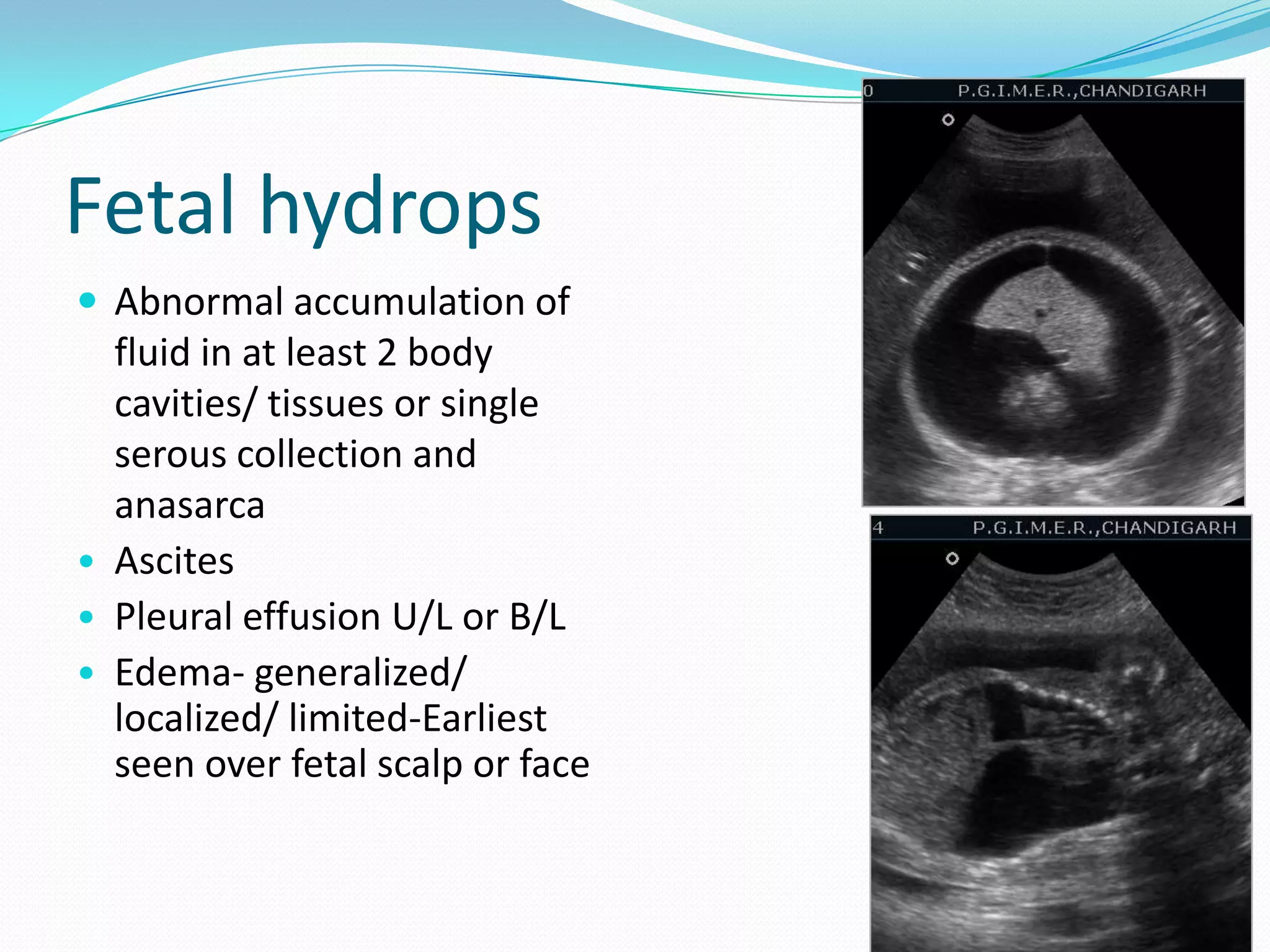 Fetal hydrops
 Abnormal accumulation of
  fluid in at least 2 body
  cavities/ tissues or single
  serous collection and
  anasarca
• Ascites
• Pleural effusion U/L or B/L
• Edema- generalized/
  localized/ limited-Earliest
  seen over fetal scalp or face


                                  30
 