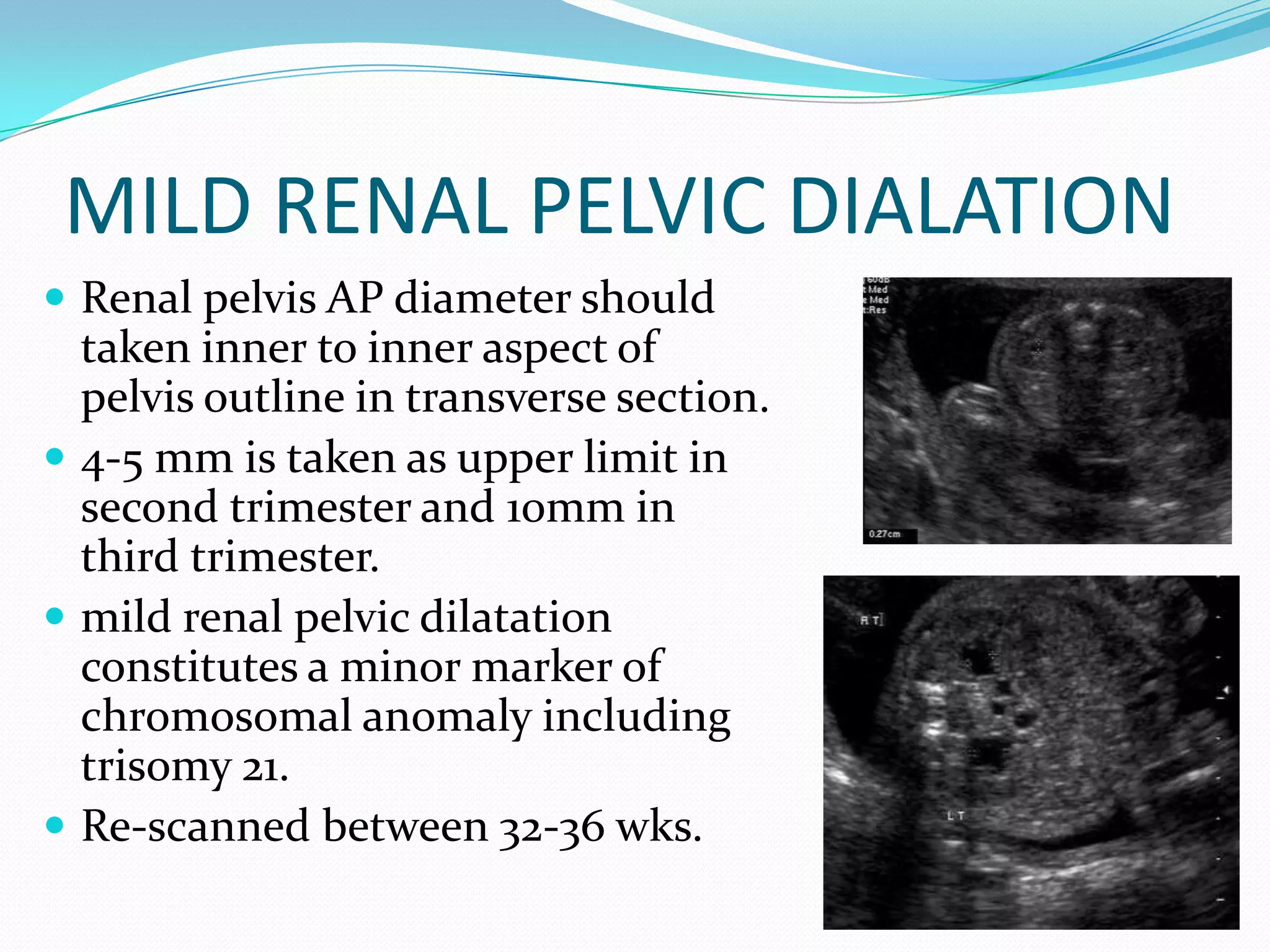 MILD RENAL PELVIC DIALATION
 Renal pelvis AP diameter should
  taken inner to inner aspect of
  pelvis outline in transverse section.
 4-5 mm is taken as upper limit in
  second trimester and 10mm in
  third trimester.
 mild renal pelvic dilatation
  constitutes a minor marker of
  chromosomal anomaly including
  trisomy 21.
 Re-scanned between 32-36 wks.
 