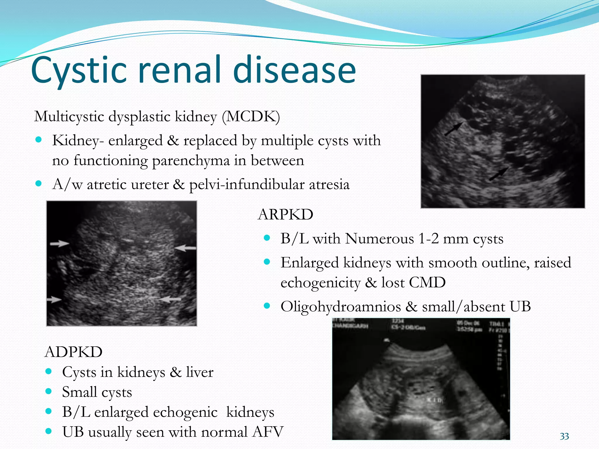 Cystic renal disease
Multicystic dysplastic kidney (MCDK)
 Kidney- enlarged & replaced by multiple cysts with
  no functioning parenchyma in between
 A/w atretic ureter & pelvi-infundibular atresia
                                 ARPKD
                                  B/L with Numerous 1-2 mm cysts
                                  Enlarged kidneys with smooth outline, raised
                                   echogenicity & lost CMD
                                  Oligohydroamnios & small/absent UB

 ADPKD
  Cysts in kidneys & liver
  Small cysts
  B/L enlarged echogenic kidneys
  UB usually seen with normal AFV                                           33
 
