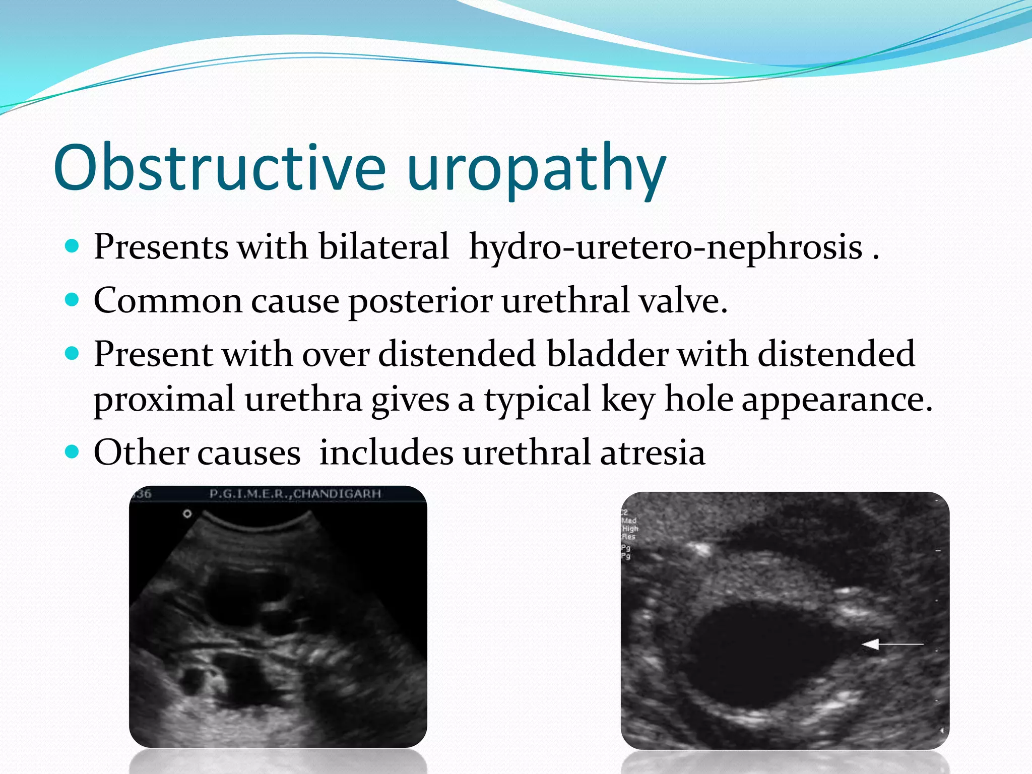 Obstructive uropathy
 Presents with bilateral hydro-uretero-nephrosis .
 Common cause posterior urethral valve.
 Present with over distended bladder with distended
  proximal urethra gives a typical key hole appearance.
 Other causes includes urethral atresia
 