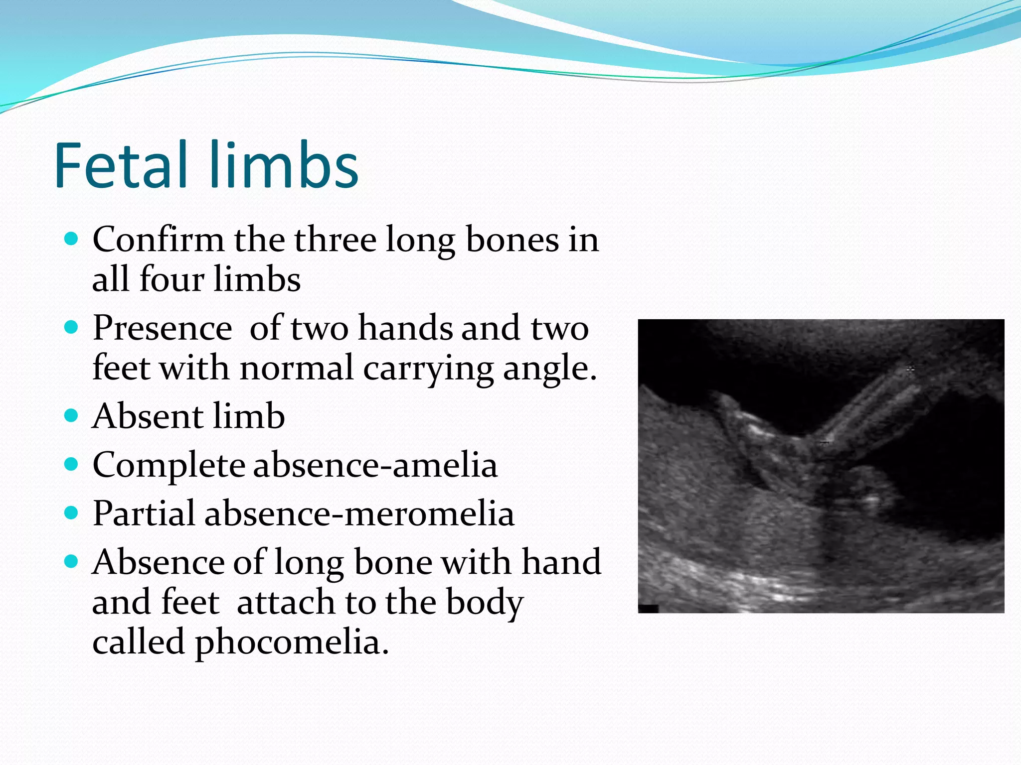 Fetal limbs
 Confirm the three long bones in
    all four limbs
   Presence of two hands and two
    feet with normal carrying angle.
   Absent limb
   Complete absence-amelia
   Partial absence-meromelia
   Absence of long bone with hand
    and feet attach to the body
    called phocomelia.
 